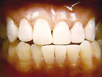 Teeth Bonding
