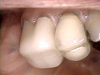 CEREC Porcelain Crowns