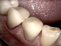 CEREC Porcelain Crowns