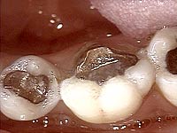 Porcelain Crowns and Dental Bridges