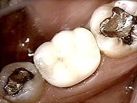 Porcelain Crowns and Dental Bridges