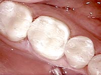 Teeth Fillings