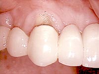 Periodontal Surgery