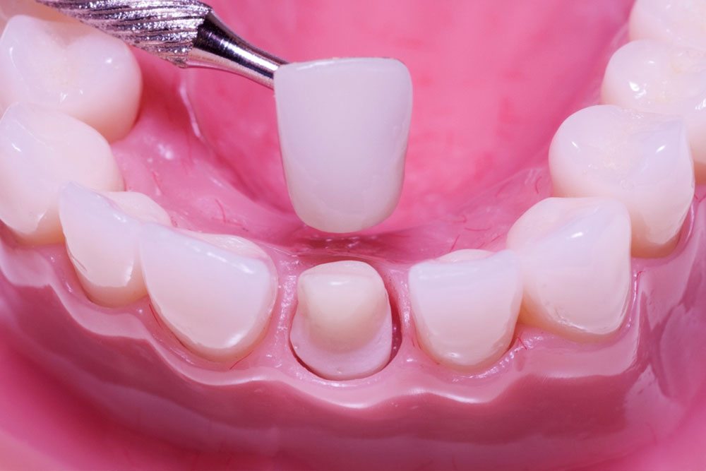 Porcelain Crowns and Dental Bridges