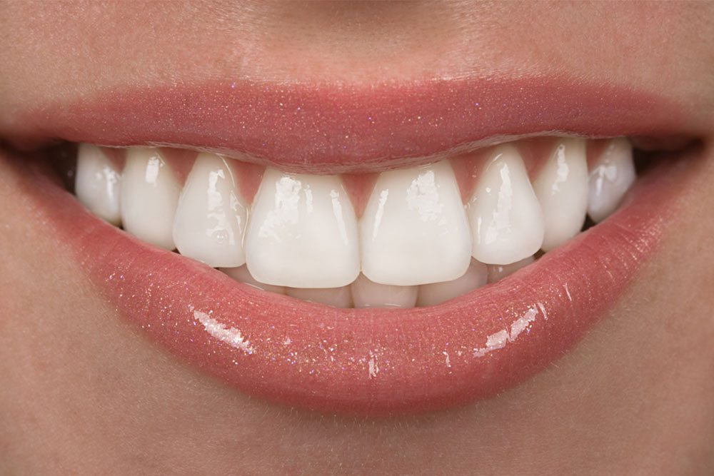 Porcelain Veneers