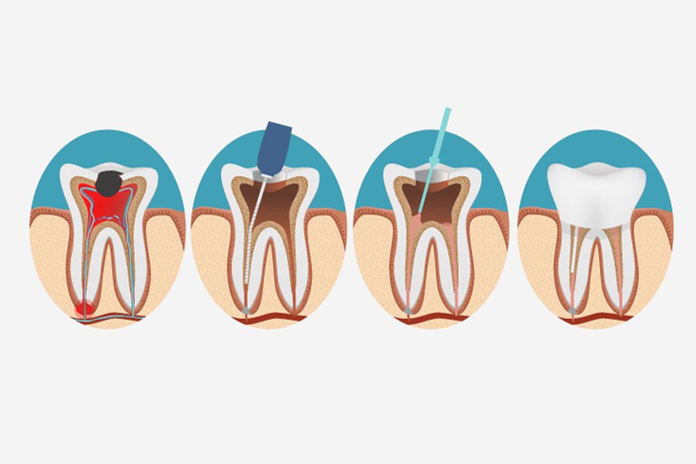 Root Canal