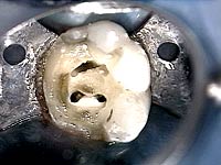 Root Canal