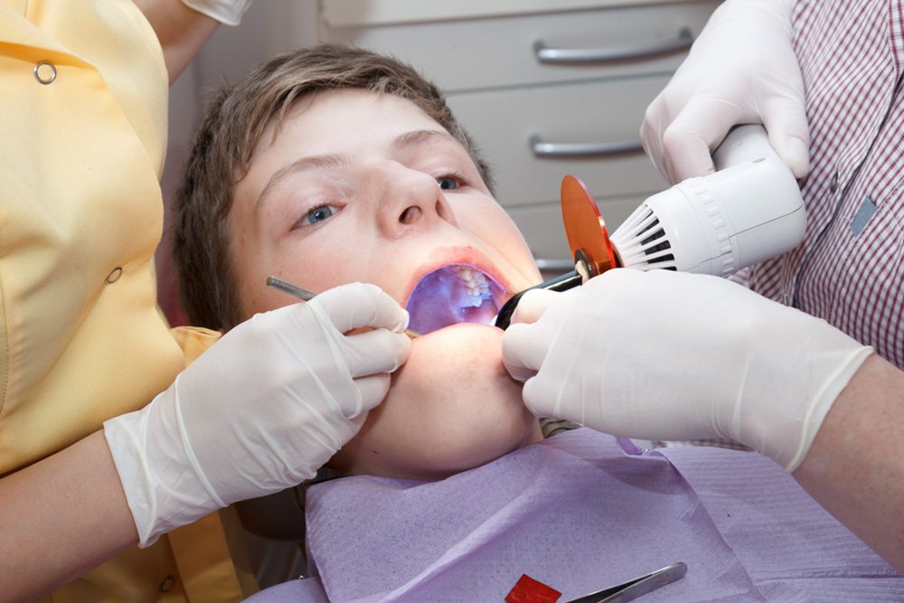 Teeth Fillings