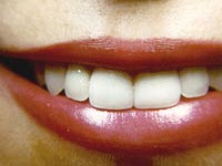 Porcelain Veneers